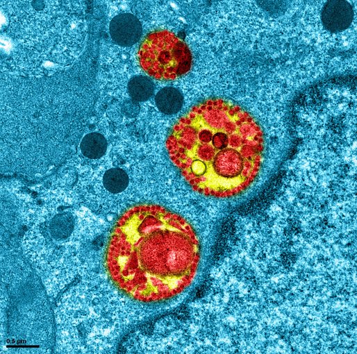 Imaginea unei celule infectate cu SARS Cov-2, publicată de Institutul Național francez de Sănătate și Cercetare Medicală