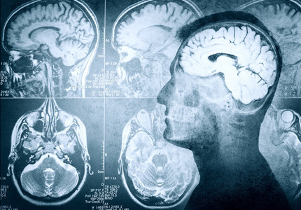 Traumatismele cranio-cerebrale sunt în creştere, fiind peste 60.000 de cazuri anual. Principala cauză: accidentele rutiere