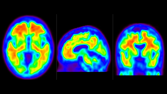 Diagnosticul precoce în maladia Alzheimer: Cercetătorii pot distinge între diferitele tipuri ale bolii