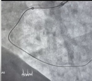 Pacient de 56 de ani cu afectare severă difuză la nivelul arterei coronare drepte, salvat de medicii de la Suceava / Leziunile calcificate subocluzive au făcut ca intervenţia să fie dificilă - VIDEO


