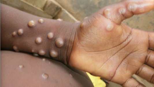 Grecia a raportat primul caz suspect de variola maimuţei