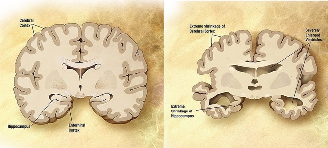 Un medicament împotriva maladiei Alzheimer a generat rezultate promiţătoare - studiu