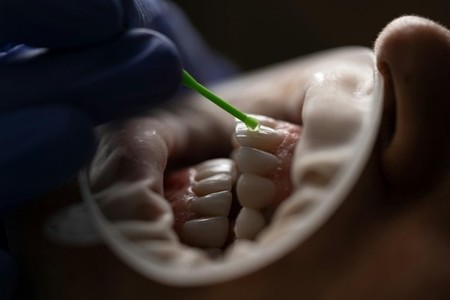 COMUNICAT DE PRESĂ: Află ACUM ce este un implant dentar şi când e cazul să-ţi faci unul!