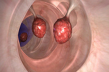 Medicii sunt socati! Acest remediu ucide 93% dintre celulele de cancer la colon in doar doua zile!