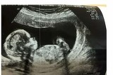 O gravida a facut sex salbatic in luna a saptea de sarcina. Ce era schimbat cu bebelusul, a doua zi, la ecografie