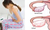 Simptomele cancerului ovarian, "asasinul tacut" care ucide milioane de femei - Mergi urgent la medic daca ai asa ceva