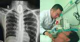 Chinezul care a trăit timp de un an cu o lingură în esofag