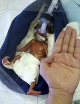Ce s-a ales de copilul care cântărea la naştere 400 de grame! Micuţa avea organele subdezvoltate, dar a supravieţuit