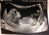 A facut sex cu 2 barbati, in zile diferite, iar apoi s-a trezit gravida! Medicii au ramas socati cand au vazut ce se intampla in uterul ei! Ce a patit o femeie dupa ce si-a inselat iubitul