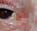 Medicii, in stare de soc! Un tanar s-a trezit cu un vierme parazit in ochi: "Nu vedea la 30 de centrimetri
