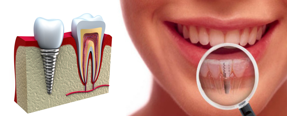 IMPLANT DENTAIRE PARIS