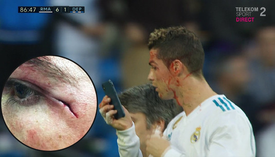 VIDEO | Imagini şocante cu accidentarea suferită de Cristiano Ronaldo! Cum arată tăietura de pe faţa lui CR7