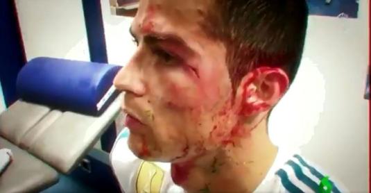 FOTO | Cum arată acum tăietura de pe faţa Cristiano Ronaldo, la două săptămâni după ce a fost umplut de sânge