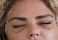 FOTO-ŞOC! Vedeta TV care a apărut desfigurată în public. Motivul pentru care are faţa plină de vânătăi