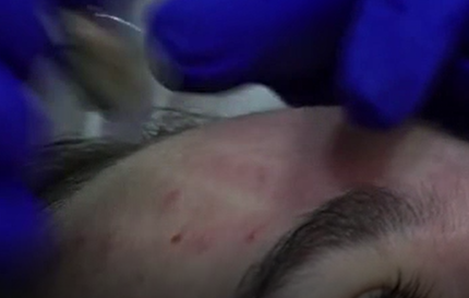 Hai cu fetele: Acneea, una dintre cele mai întâlnite afecţiuni dermatologice