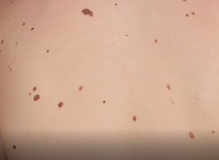 Sănătate cu stil: Când o aluniţă poate deveni periculoasă