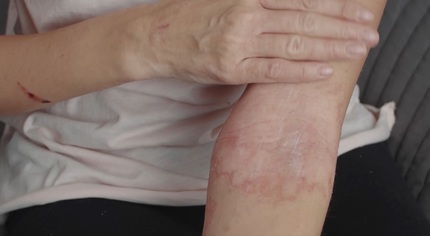 VIDEO Sănătate cu stil: Îngrijirea pielii în lupta cu cancerul