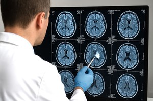 Obezitatea şi un aport scăzut al unui nutrient vital ar putea accelera îmbătrânirea creierului