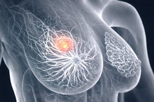 Novartis va plăti 3 miliarde de dolari pentru un medicament experimental împotriva cancerului de sân