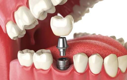 Avantajele și dezavantajele implanturilor dentare pentru înlocuirea dinților pierduți