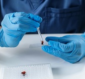 Statele Unite aprobă primul test de sânge pentru depistarea bolii Alzheimer