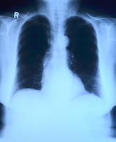 Românii pot afla dacă au risc de a dezvolta cancer pulmonar cu ajutorul unui test online