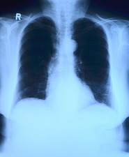 Românii pot afla dacă au risc de a dezvolta cancer pulmonar cu ajutorul unui test online