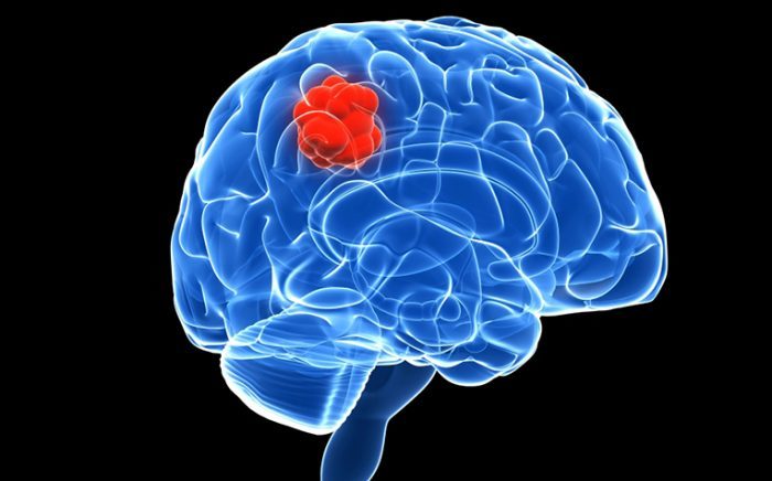 Cauze și simptome ale tumorii cerebrale