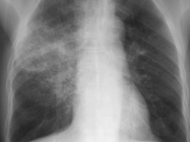 Creştere accentuată a cazurilor de pneumonie depistate la Spitalul de Boli Infecţioase Timişoara. Zeci de pacienţi, diagnosticaţi în ultima săptămână
