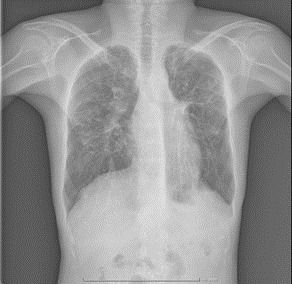 Medicii pneumologi din Timişoara atrag atenţia că sunt multe cazuri nediagnosticate de fibroză chistică / Care sunt simptomele bolii şi cum se poate interveni 