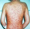Copil în vârstă de 7 ani cu o boală rară, internat la Spitalul de Boli Infecţioase din Timişoara/ Băiatul suferă de varicelă hemoragică
