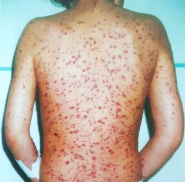 Copil în vârstă de 7 ani cu o boală rară, internat la Spitalul de Boli Infecţioase din Timişoara/ Băiatul suferă de varicelă hemoragică
