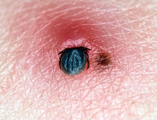 Aproape 20 de pacienţi s-au prezentat la Spitalul de Boli Infecţioase Timişoara, cu muşcătură de căpuşă / Sfatul medicilor