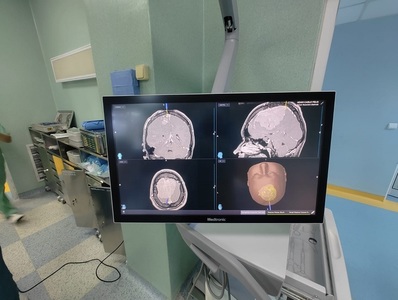 Tânăr cu o tumoră de nouă centimetri la creier, operat la Spitalul de Neurochirurgie din Iaşi. Medic: Apar tot mai multe astfel de cazuri la tineri, pe fondul vieţii stresante - FOTO
