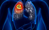 Aproape 700 de cazuri noi de cancer pulmonar, la Institutul Marius Nasta, în primele şase luni ale anului / Beatrice Mahler: Cancerul pulmonar rămâne una dintre cele mai răspândite şi letale forme de cancer în întreaga lume / Recomandările medicului