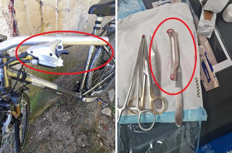 Un medic de la Spitalul Urlaţi, acuzat că a cusut în piciorul unui pacient mânerul de frână de la bicicletă, apoi l-a trimis acasă / Unitatea sanitară a declanşat o cercetare internă