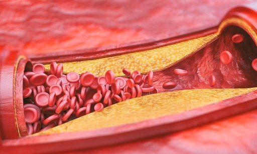 Semnal de alarmă tras de specialiştii Spitalului Clinic CF Timişoara: Număr crescut de pacienţi cu ateroscleroză, principala cauză de producere a unui infarct miocardic