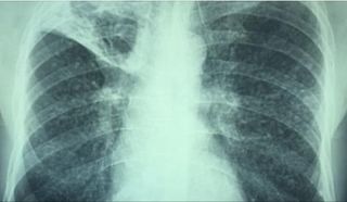 Aproximativ 2.3 milioane de români suferă de o boală respiratorie. Boala pulmonară obstructivă cronică afectează 8,3% din populaţia cu vârsta peste 40 de ani