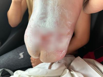 Copil de un an din judeţul Iaşi, adus cu elicopterul SMURD la spital după ce a căzut într-un vas cu apă fierbinte. A fost afectată un sfert din suprafaţa corpului