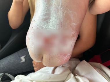 Copil de un an din judeţul Iaşi, adus cu elicopterul SMURD la spital după ce a căzut într-un vas cu apă fierbinte. A fost afectată un sfert din suprafaţa corpului