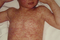 Sandra Alexiu: Zone întregi din România sunt bombardate de mediile închise, deseori religioase, cu informaţii false despre vaccinuri/ Acolo, România a înregistrat constant focare epidemice de rujeolă/ România nu îşi asumă cu curaj salvarea copiilor ei