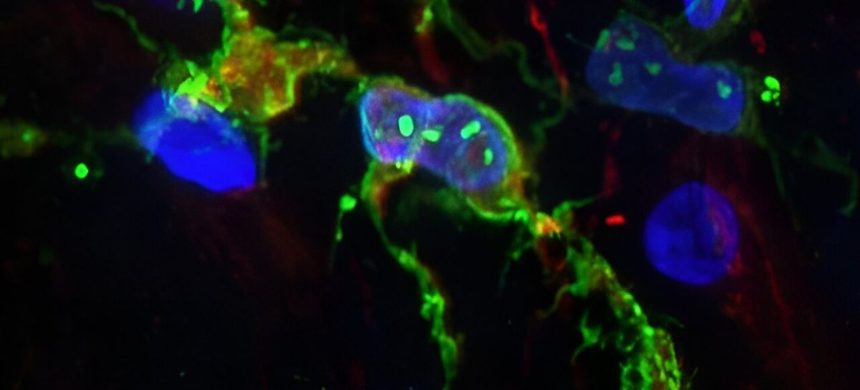 Modificări în celulele imune ale creierului, legate de boala Alzheimer