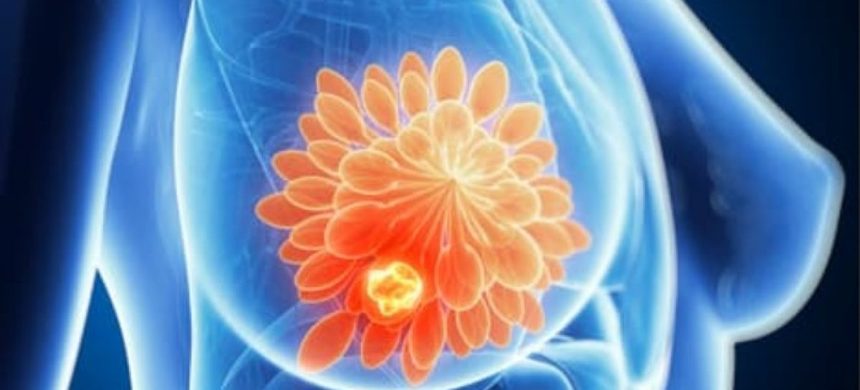 Noi gene de risc pentru cancerul de sân, descoperite de cercetători într-un studiu internaţional de amploare