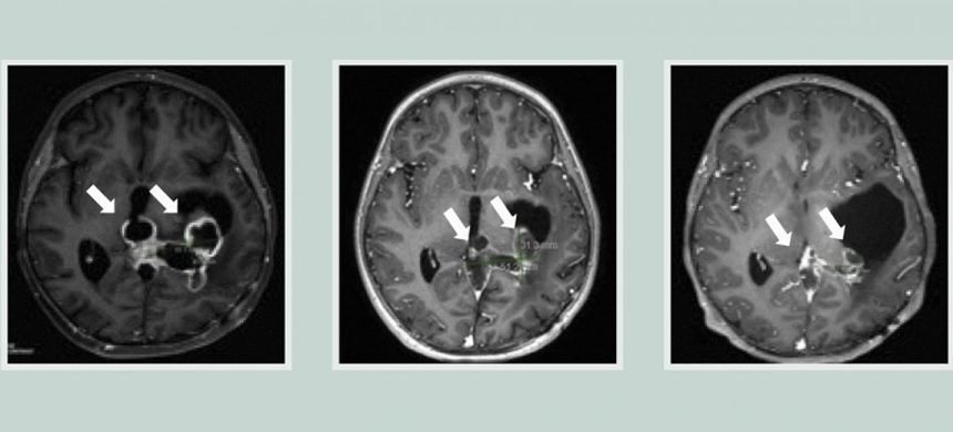 Medicament experimental, testat clinic pentru tratarea tumorilor cerebrale agresive