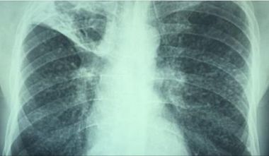 STUDIU despre interpretarea radiografiilor toracice: Inteligenţa artificială versus radiologi cu experienţă