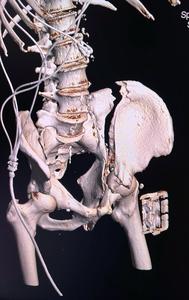 Prima intervenţie de osteosinteză cu machetă 3D preoperator, la Spitalul Clinic Judeţean de Urgenţă Târgu Mureş