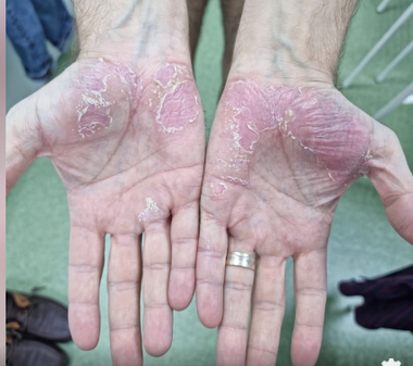 Medic: Psoriazis, o afecţiune cronică a pielii care afectează milioane de oameni din întreaga lume, nu se vindecă niciodată, dar poate fi ţinută sub control