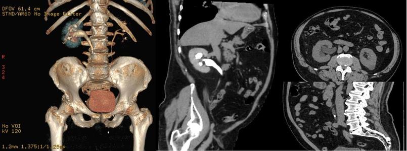 Urografia prin tomografie computerizată, investigaţie gratuită la Spitalul de Boli Infecţioase ”Victor Babeş” Timişoara