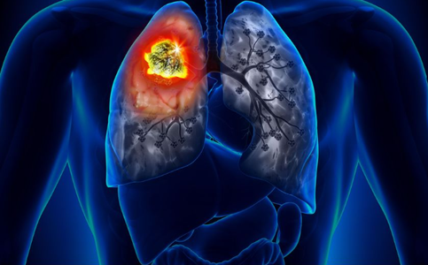 O imunoterapie ţintită pentru tratamentul cancerului pulmonar, autorizată în SUA