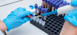 Tehnică nouă pentru detectarea biomarkerilor în bolile renale